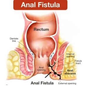 पोतो (Fistula / Anal Fistula) र पायल्स (Piles / Hemorrhoids)/ फिसर Fissure